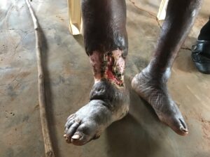 Clinical before photograph from Tadeo's outreach case